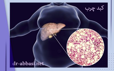 کبد چرب غیر الکلی ; علائم تا درمان