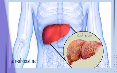 همه چیز درمورد سیروز کبدی؛ علائم تا درمان