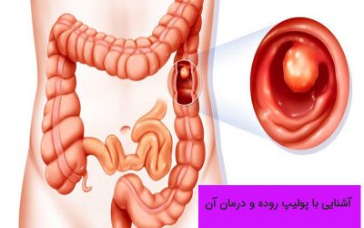 پولیپ روده بزرگ چیست؟ علائم و انواع آن کدامند؟