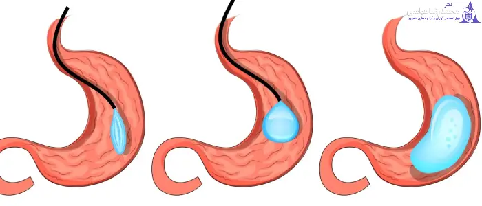 بوتاکس معده بهتر است یا بالن؟